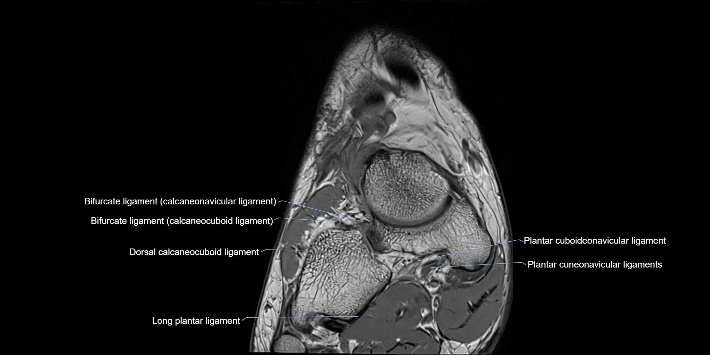 MRI Ankle coronal ligaments cross sectional anatomy 3T  radiology  image-img-00001-00001.webp